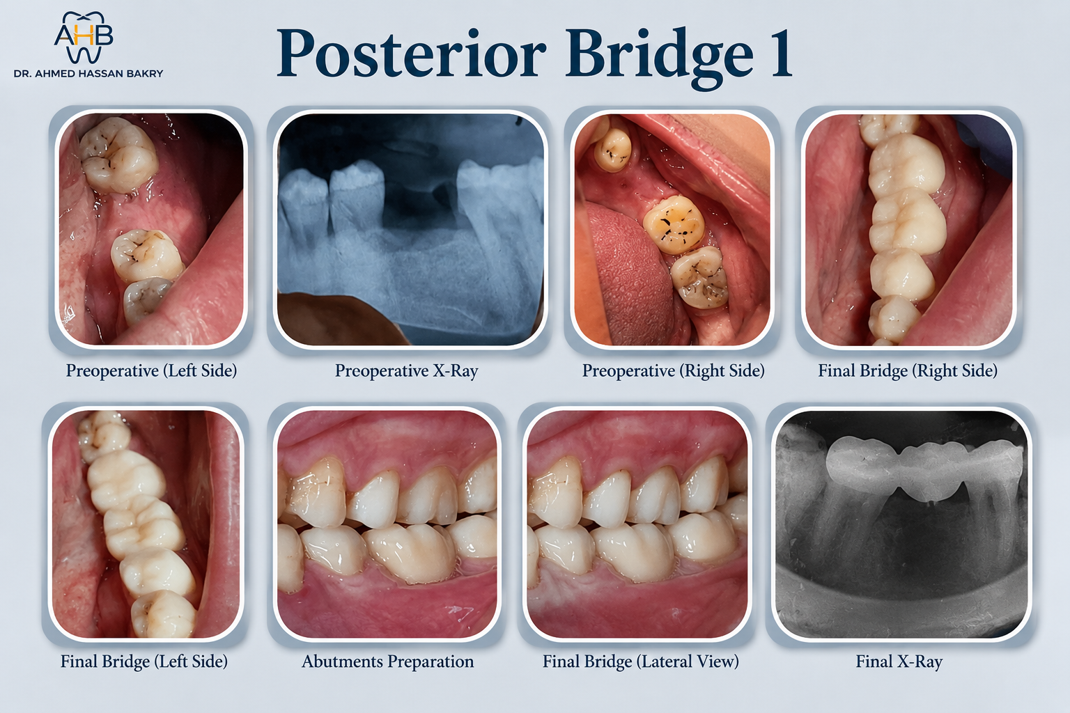 Posterior Bridge (Case 1)